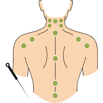 Acupuncture 